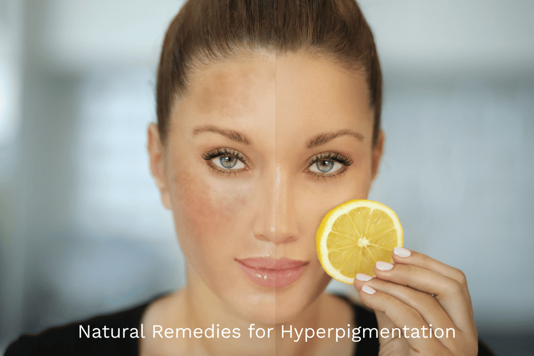 Picture of a woman with skin pigmentation